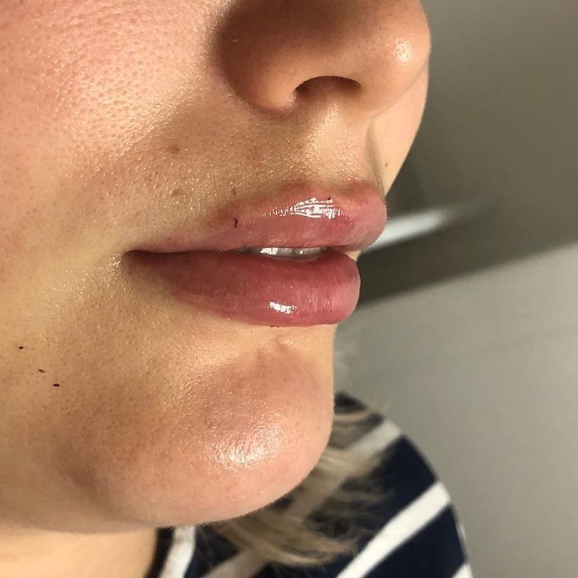 Lip Filler